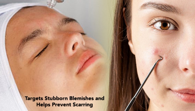 Picture 2 of Deluxe Microderm Blemish and Pore Cleaning System -  Smoother, Brighter Skin