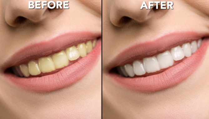 Click to view picture 5 of Bright Whites Complete Teeth Whitening Kit